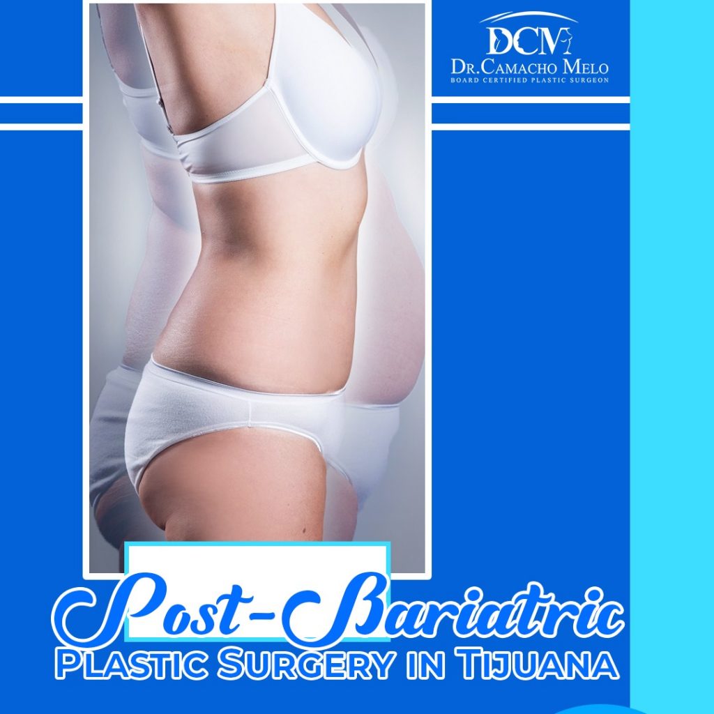 Post-Bariatric Plastic Surgery in Tijuana